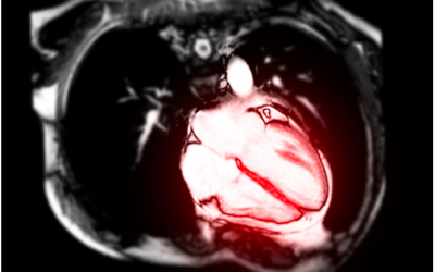 Cardiologist Estimates 30 Percent of U.S. Pilots May Have COVID Jab-Induced Heart Conditions