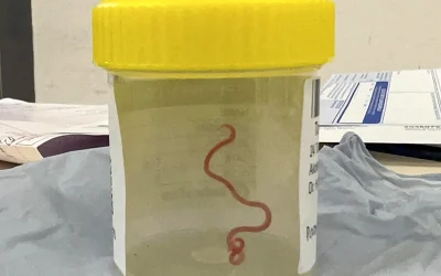 Doctors Discover World-First Live Worm In Australian Woman’s Brain oan