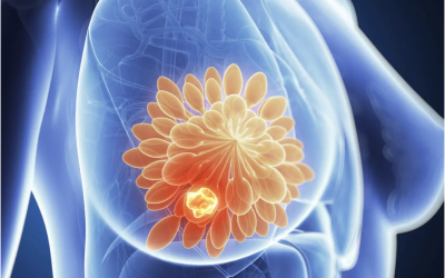 Overdiagnosis of Breast Cancer in Older Women—and Unnecessary Treatment—Is Widespread: Study