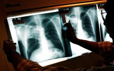 Deadly Lung Disease Cases Surge To 10-Year High, Children Most Affected: CDC