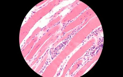 COVID-19 And Vax Contributed To Increase In Rare Autoimmune Disease In 2021: Study