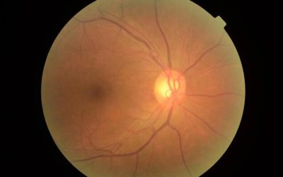 Scientists Identify New Protein That Drives Age-Related Blindness, Uncover Potential Therapy