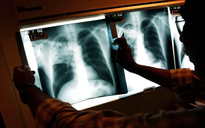 Kansas Faces ‘Largest Tuberculosis Outbreak In U.S. History’ oan