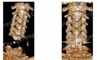 Robot Nearly Decapitates Man In Gruesome Surgery Fail