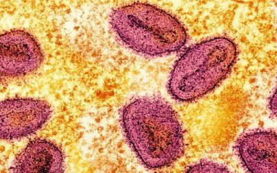 Severe Mpox Virus Strain Possibly Spreading In LA County, Officials Warn