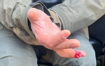 Lefty Protestor Bites Off Federal Officer’s Finger