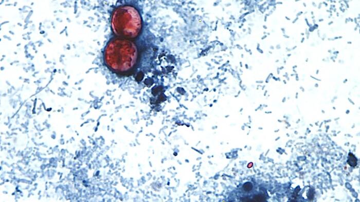 Disease Caused By Cyclospora Parasite Now In 45 States: CDC